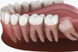 Wisdom Teeth Removal